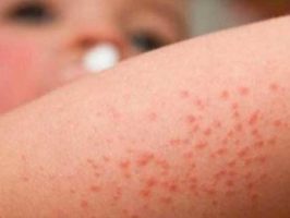 ESPAINIAKO BIZTANLERIAREN %3AK BAINO GEHIAGOK DERMATITIS ATOPIKOA DU